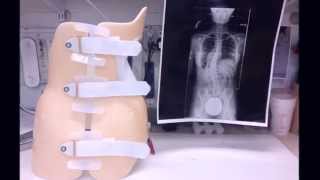 Rubys Scoliosis Journey 💕 Tips and Tricks for Brace [upl. by Margetts]