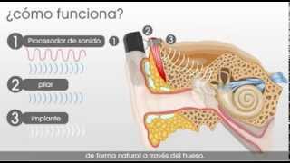 SH Medical Group  Como funciona el sistema auditivo Cochlear Baha [upl. by Hanima]