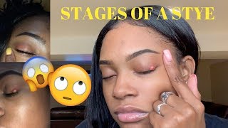 STAGES OF A STYE  CURE 👁 [upl. by Boles]