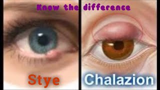 Difference between Stye and Chalazion [upl. by Crowell]