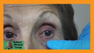 A Stye and a Chalazion  Auburn Medical Group [upl. by Ambrosine]