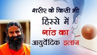 शरीर के किसी भी हिस्से में गांठ का आयुर्वेदिक इलाज  Swami Ramdev [upl. by Aindrea]