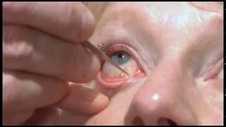 Oculoplastics basic exam Lacrimal system examination [upl. by Annabella691]