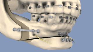 BSSO amp Osseous Genioplasty [upl. by Thynne]