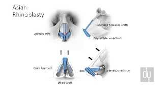 AllInside ACL Reconstruction with Arthrex® GraftLink® [upl. by Wong512]