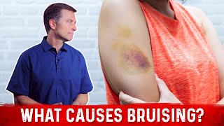 What Causes Bruising Without Trauma – Dr Berg [upl. by Atteroc]